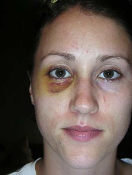 Rob Porter told White House senior staff ex-wife's black eye was accidental: Sources